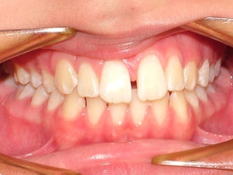 Upper space closure on a teenage patient before 1023328