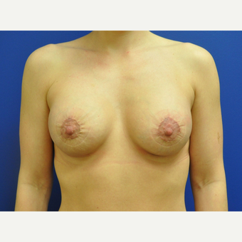25-34 year old woman treated with Breast Lift with Implants after 3299845