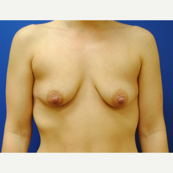 25-34 year old woman treated with Breast Lift with Implants before 3299845