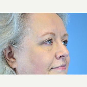 55-64 year old woman treated with Eyelid Surgery after 2224566