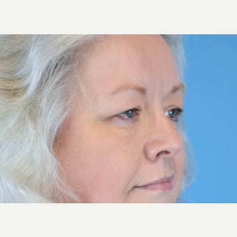 55-64 year old woman treated with Eyelid Surgery before 2224566