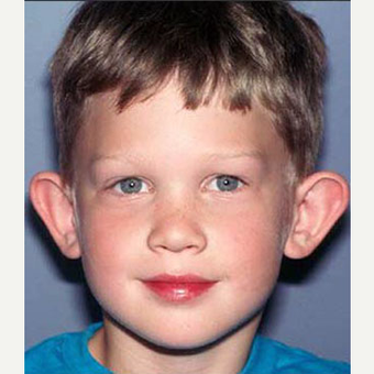17 or under year old man treated with Ear Surgery before 3711721