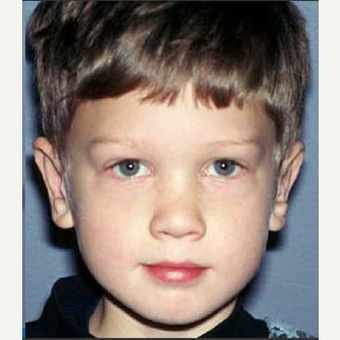 17 or under year old man treated with Ear Surgery after 3711721