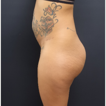25-34 year old woman treated with 712cc Implants and Fat Transfer For Her Butt Augmentation before 3129109