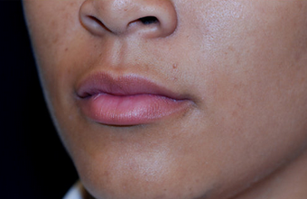 Restylane 82768