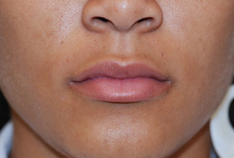 Restylane after 82768