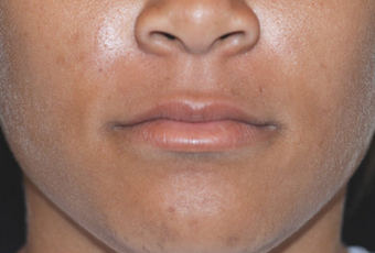 Restylane before 82768