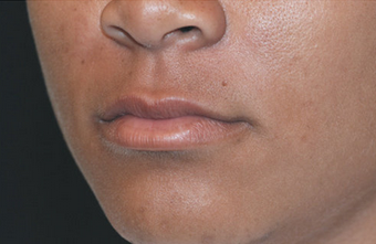Restylane 82768