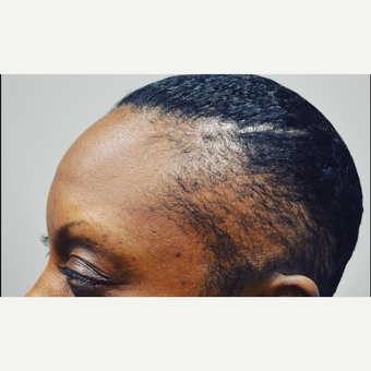 35-44 year old woman treated with FUE Hair Transplant before 3414982
