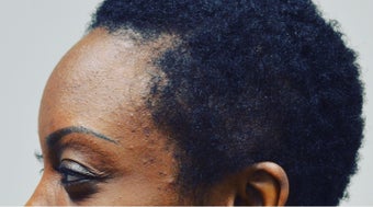 35-44 year old woman treated with FUE Hair Transplant after 3414982