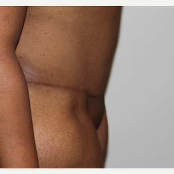 35-44 year old woman treated with Tummy Tuck after 3493567