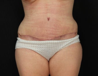 34 year old female with abominoplasty (tummy tuck) and liposuction of hips after 3576184