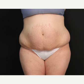 34 year old female with abominoplasty (tummy tuck) and liposuction of hips before 3576184