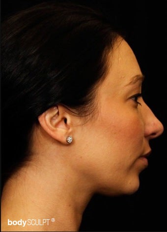 25-34 year old woman treated with Kybella after 3101522