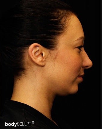 25-34 year old woman treated with Kybella before 3101522