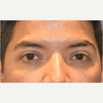 Lower blepharoplasty after 3248022