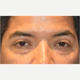 Lower blepharoplasty before 3248022