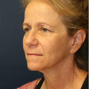 45-54 year old woman treated with Neck Lift before 3555326
