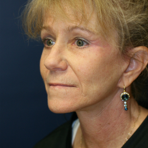 45-54 year old woman treated with Neck Lift after 3555326
