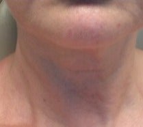 55-64 year old woman treated with Kybella after 3174611