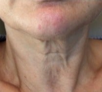 55-64 year old woman treated with Kybella before 3174611