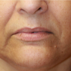 55-64 year old woman treated with Lip Lift before 3560849
