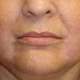 55-64 year old woman treated with Lip Lift after 3560849