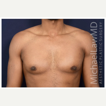 25-34 year old man treated with Male Breast Reduction after 3174090