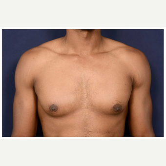 25-34 year old man treated with Male Breast Reduction before 3174090