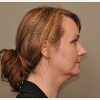 35-44 year old woman treated with Kybella before 3446708