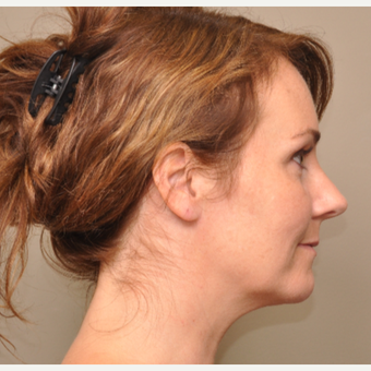 35-44 year old woman treated with Kybella after 3446708