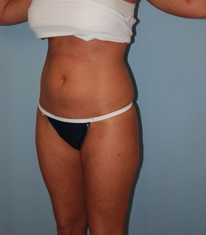 Smart Lipo before 1409625