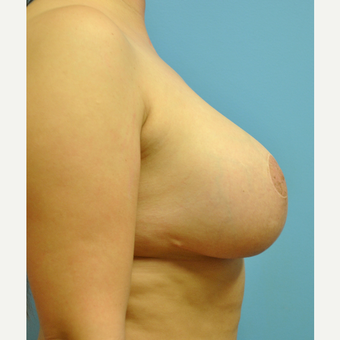 31 year old woman treated with Breast Implant Revision, mastopexy and implant exchange after 3506924