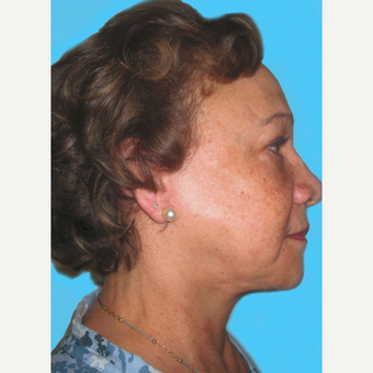 Facelift after 3826850