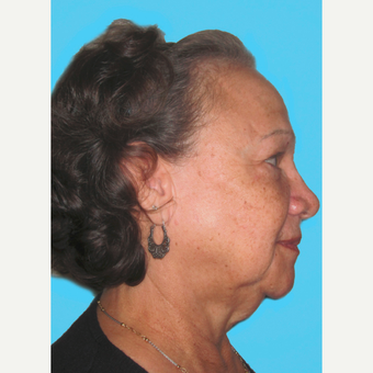 Facelift before 3826850