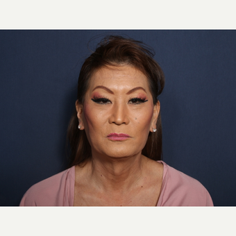 45-54 year old woman treated with Facelift (view 1 of 2) before 3103558