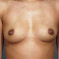 25-34 year old woman treated with Breast Augmentation before 2202498
