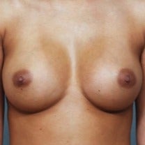 25-34 year old woman treated with Breast Augmentation after 2202498