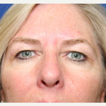 45-54 year old woman treated with Eyelid Surgery before 3094172