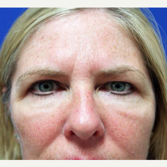 45-54 year old woman treated with Eyelid Surgery after 3094172