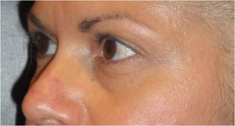Restylane 690393