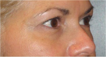 Restylane before 690393
