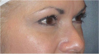 Restylane after 690393