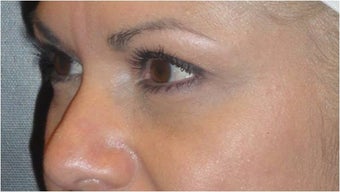 Restylane 690393