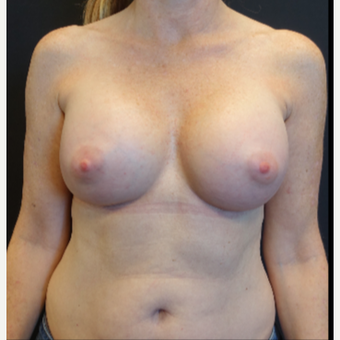 35-44 year old woman treated with Breast Augmentation after 3529780