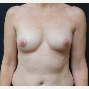 35-44 year old woman treated with Breast Augmentation before 3529780