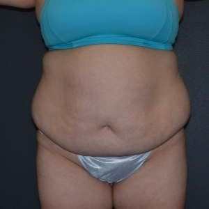 25-34 year old woman treated with Tummy Tuck before 3738028