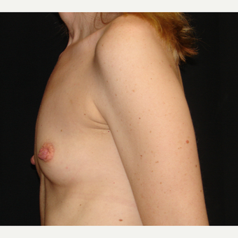 35-44 year old woman treated with Breast Augmentation before 3303897