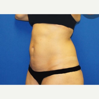 53 year old woman treated with Mini Tummy Tuck and Contour Liposuction 1588613