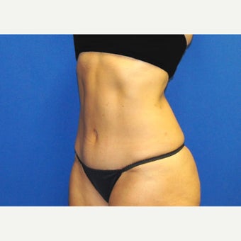 53 year old woman treated with Mini Tummy Tuck and Contour Liposuction 1588613